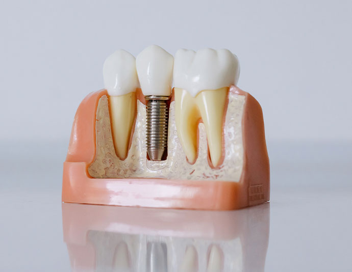 Maqueta de implantes dentales