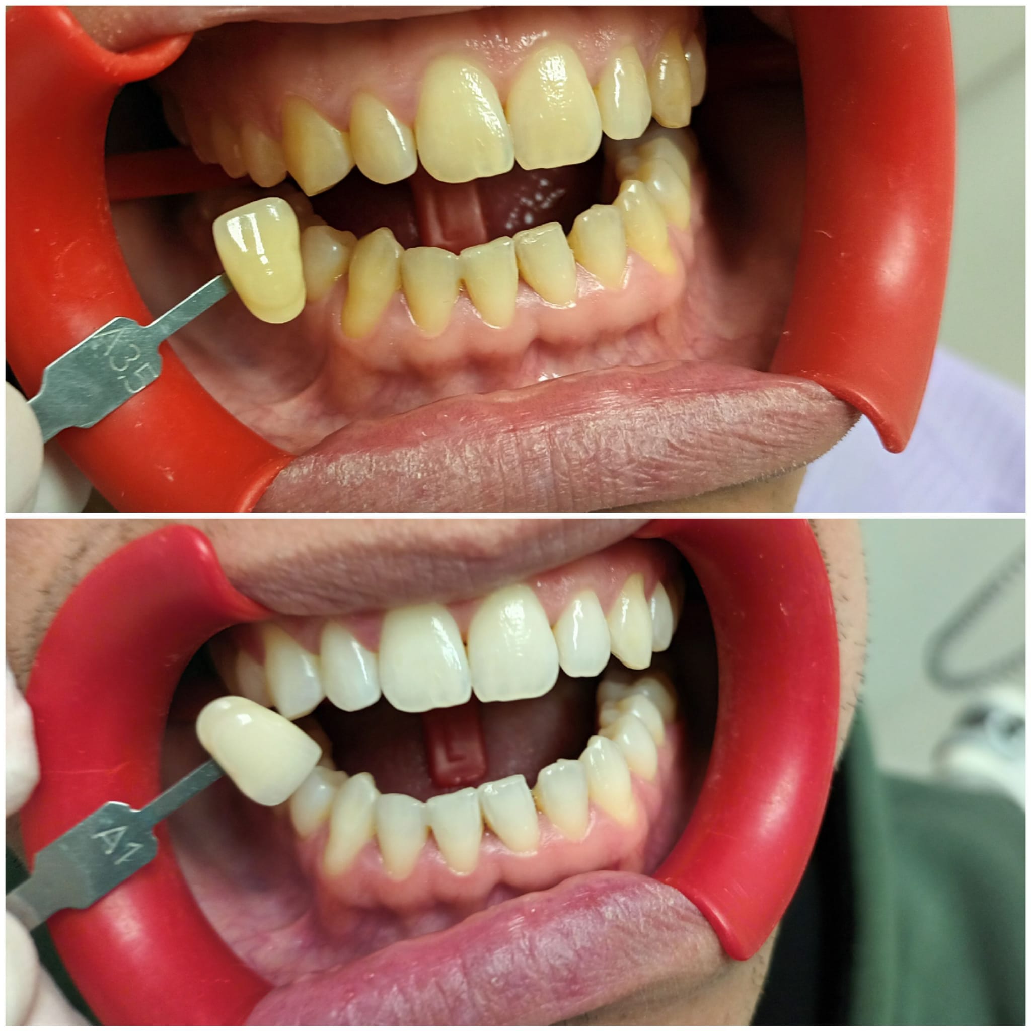 Caso real blanqueamiento dental