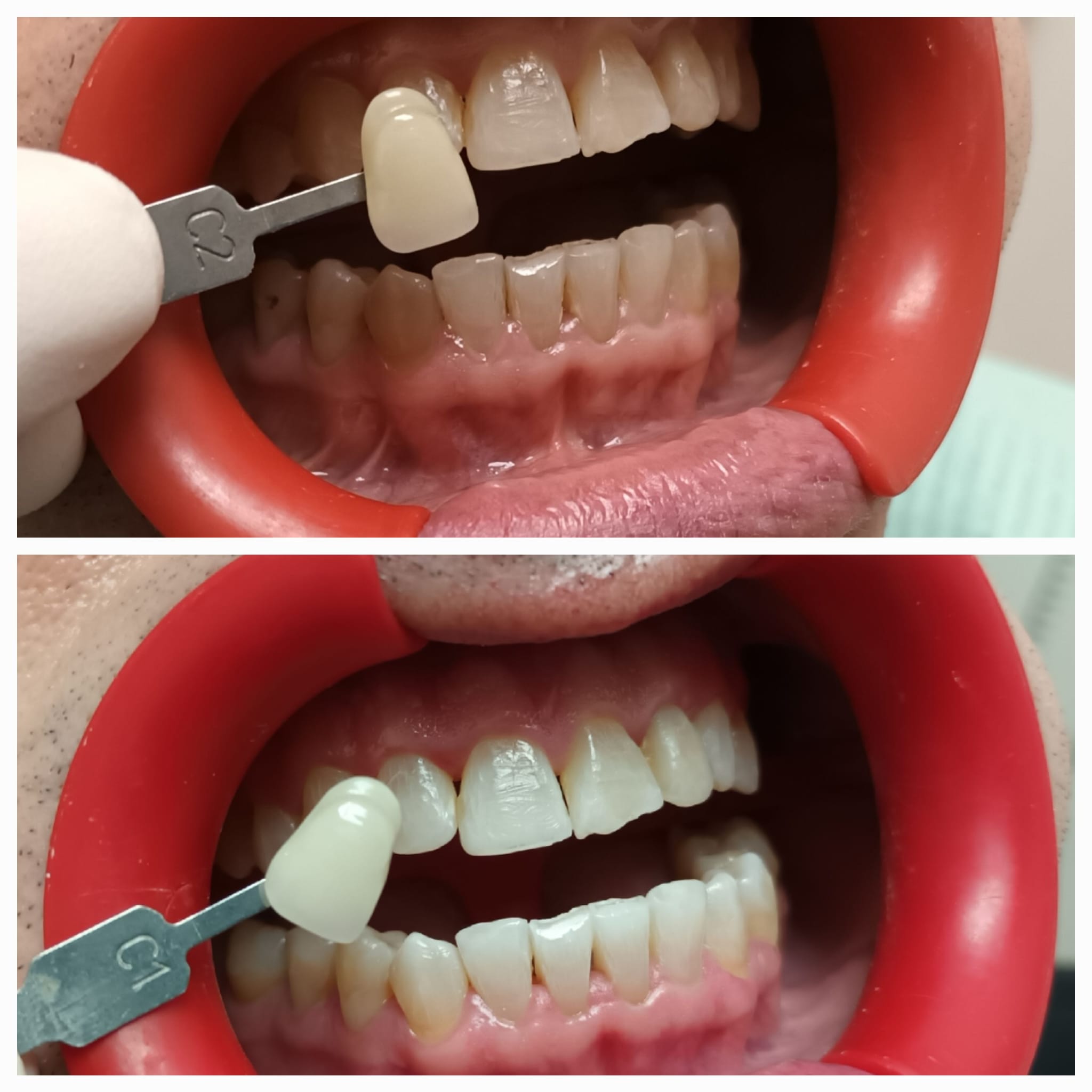 Caso real blanqueamiento dental
