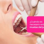 extraer muelas juicio