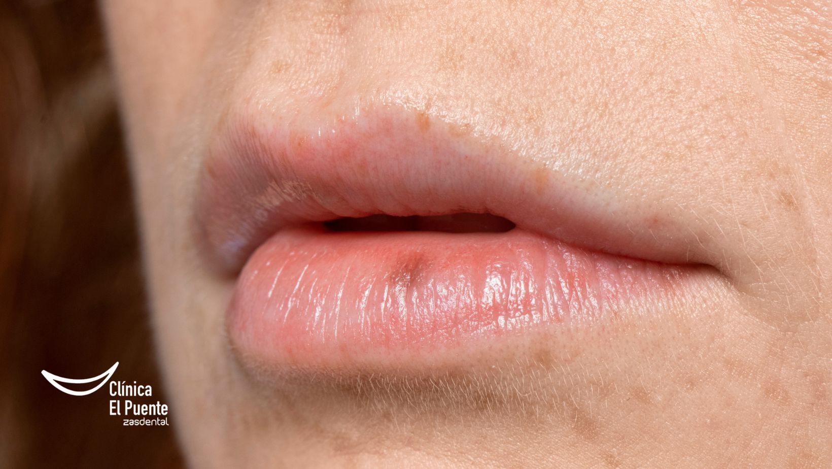 Aftas o llagas en la boca