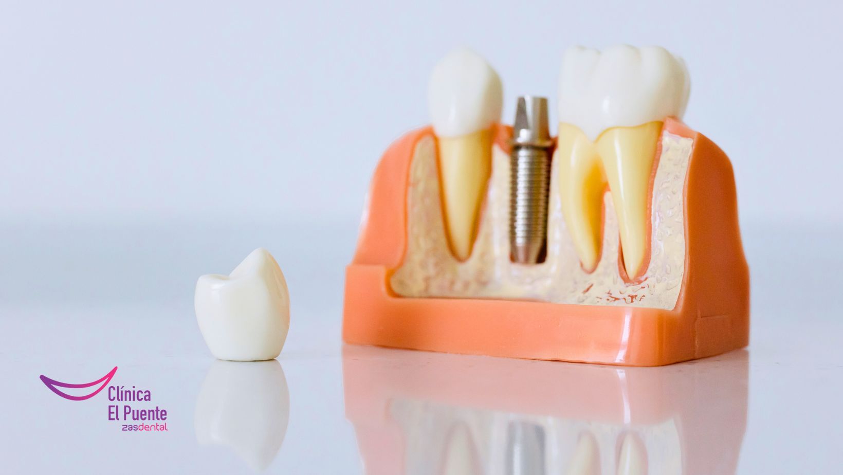 Modelo anatómico de implante dental de titanio con corona — Clínica El Puente Zas Dental Murcia