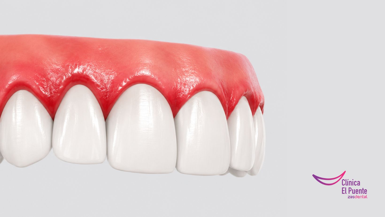 Encías inflamadas por periodontitis — Clínica El Puente Zas Dental Murcia